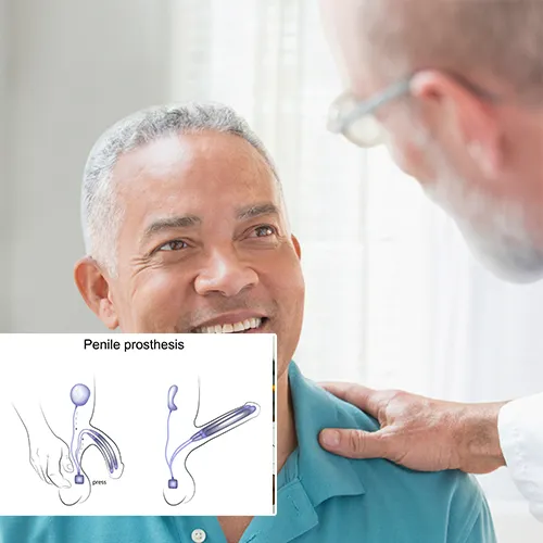 Getting Started with Your Penile Implant Journey